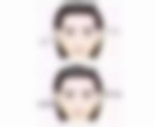 深圳健丽去除下眼袋值不值