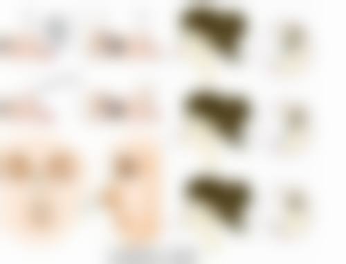 呼和浩特京美医疗美容医院割双眼皮有后遗症吗