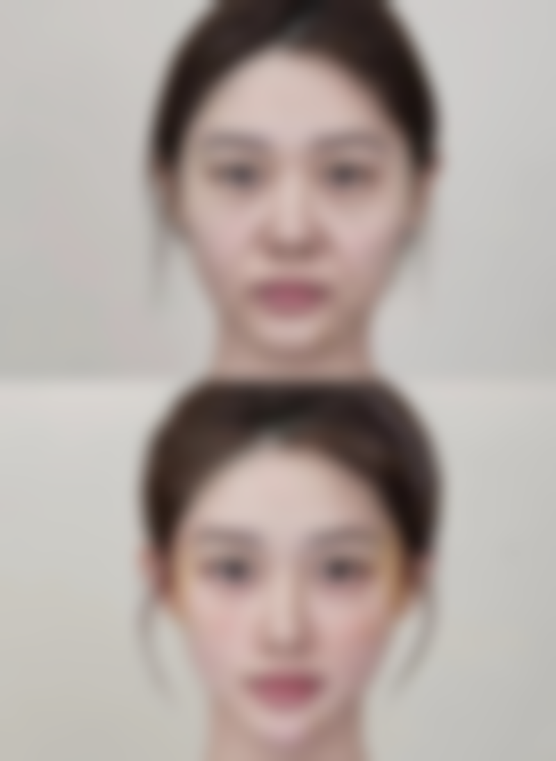 沈阳美莱医疗美容医院假体隆胸取出值不值?风险能有效控制吗?