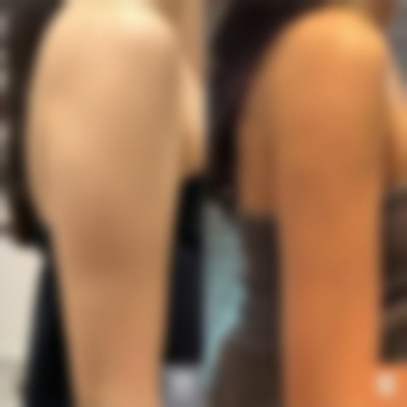 沈阳元辰医疗美容门诊部调宽埋线双眼皮有优势吗