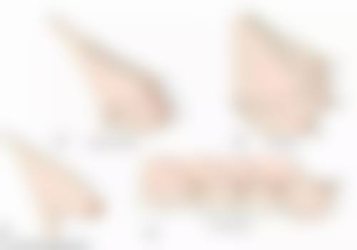 武科 大附属紫荆医院医疗美容科做双眼皮后吃芒果合适吗？