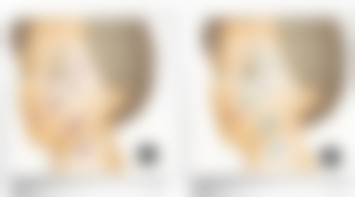 韩国原辰整形外科处理假体隆胸后半年还特别硬怎么样