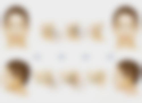 西安画美整形医院做埋线后全切双眼皮适合吗？