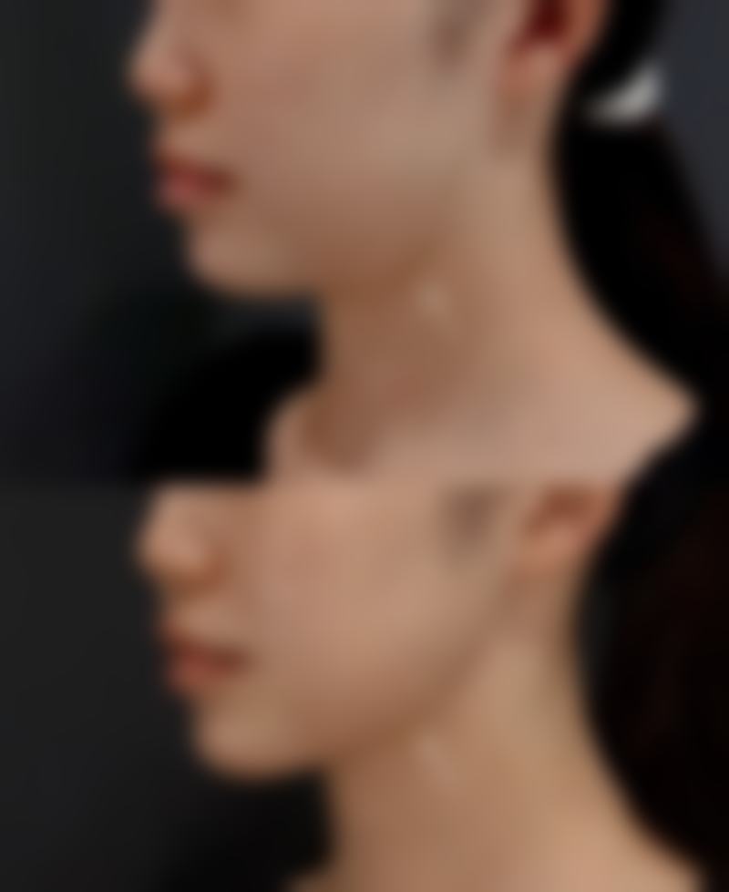 北京圣嘉新医疗美容医院做双眼皮后吃芒果值不值？