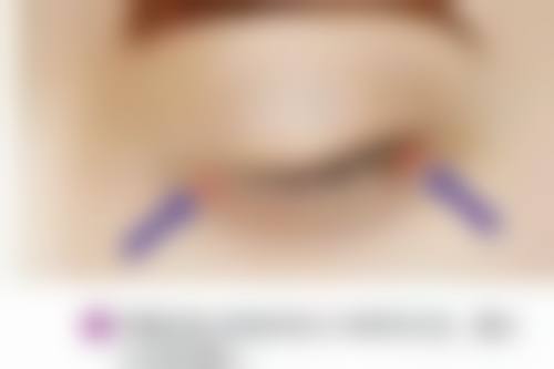 韩国原辰整形医院隆胸后取假体变形几率大吗