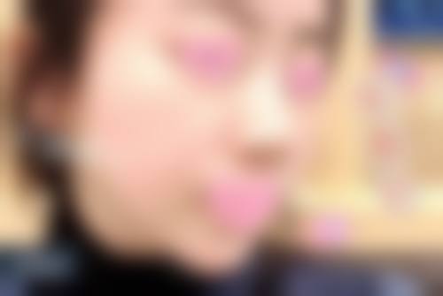 成都军建医院疤痕修复去除膝盖凸起疤痕靠谱吗？