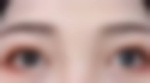 沈阳杏林整形医院干预小孩双眼皮成型可行吗