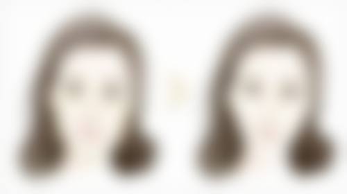 北京圣嘉新医疗美容医院隆胸后取假体变形受哪些因素影响