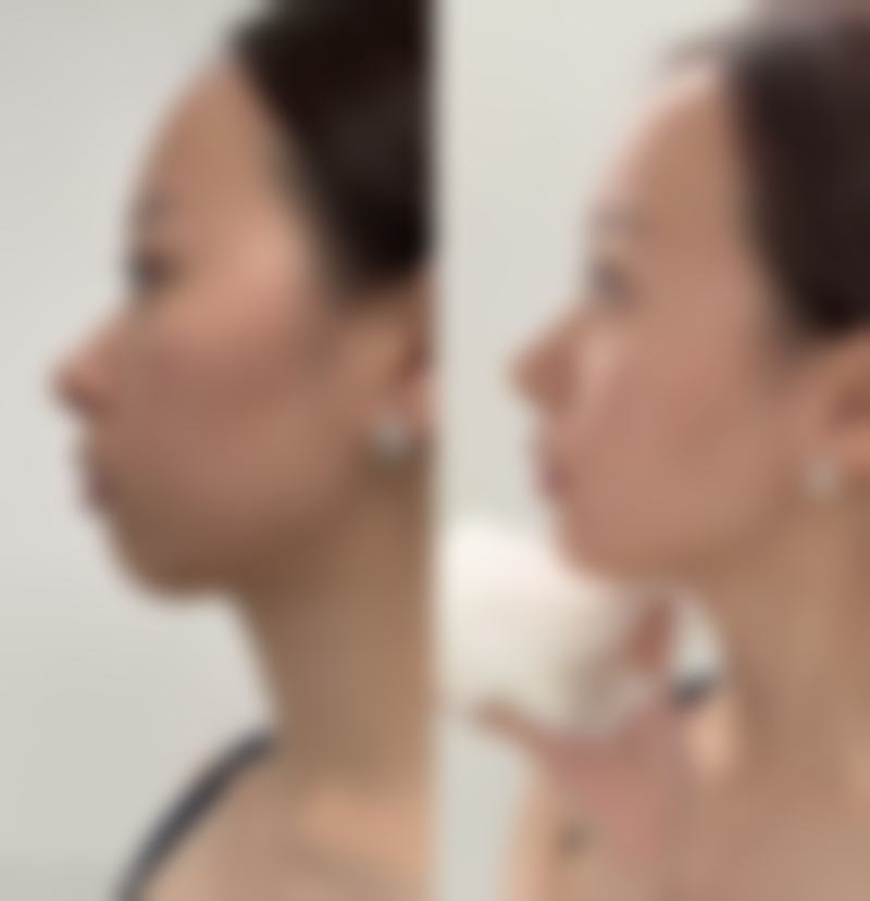 沈阳杏林整形去除膝盖凸起疤痕值不值？