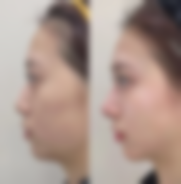 保定市虞美人医疗美容真实实例