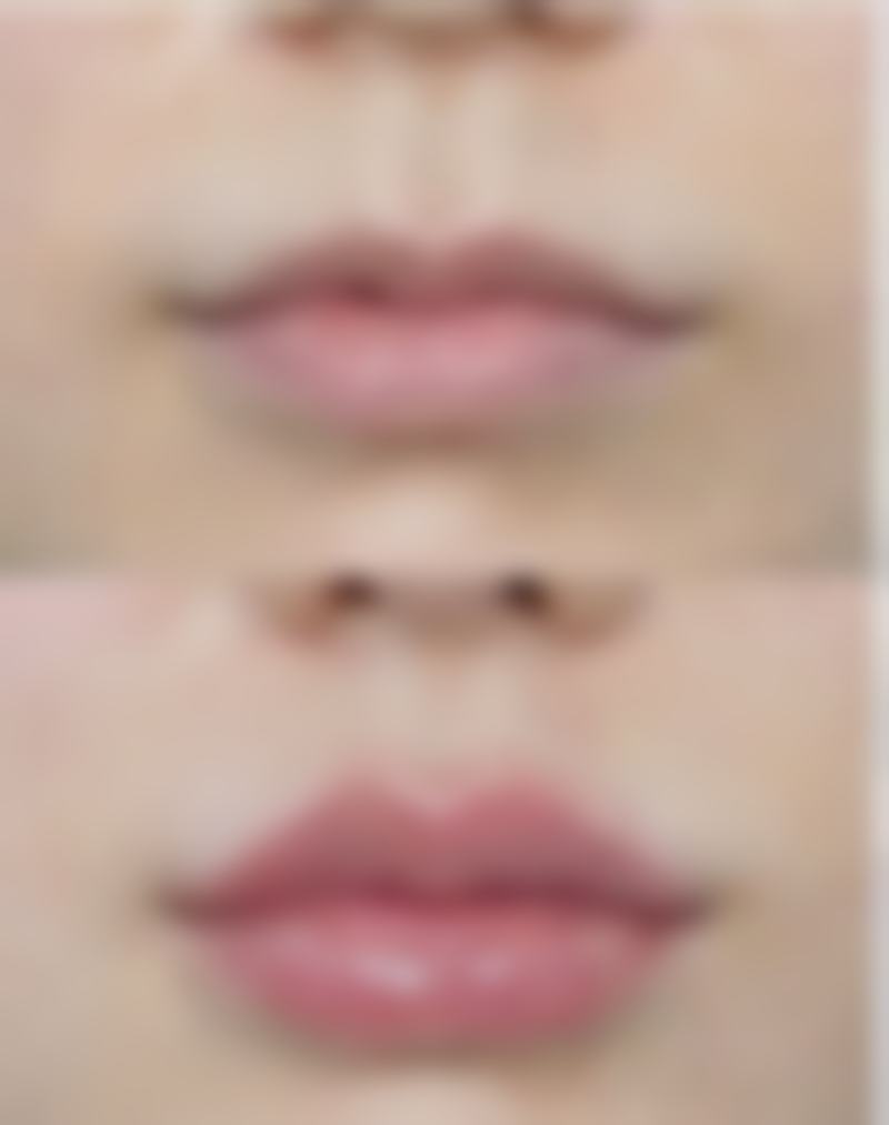 北京嘉禾医疗美容做双眼皮后如何消肿,成效适合所有人吗?