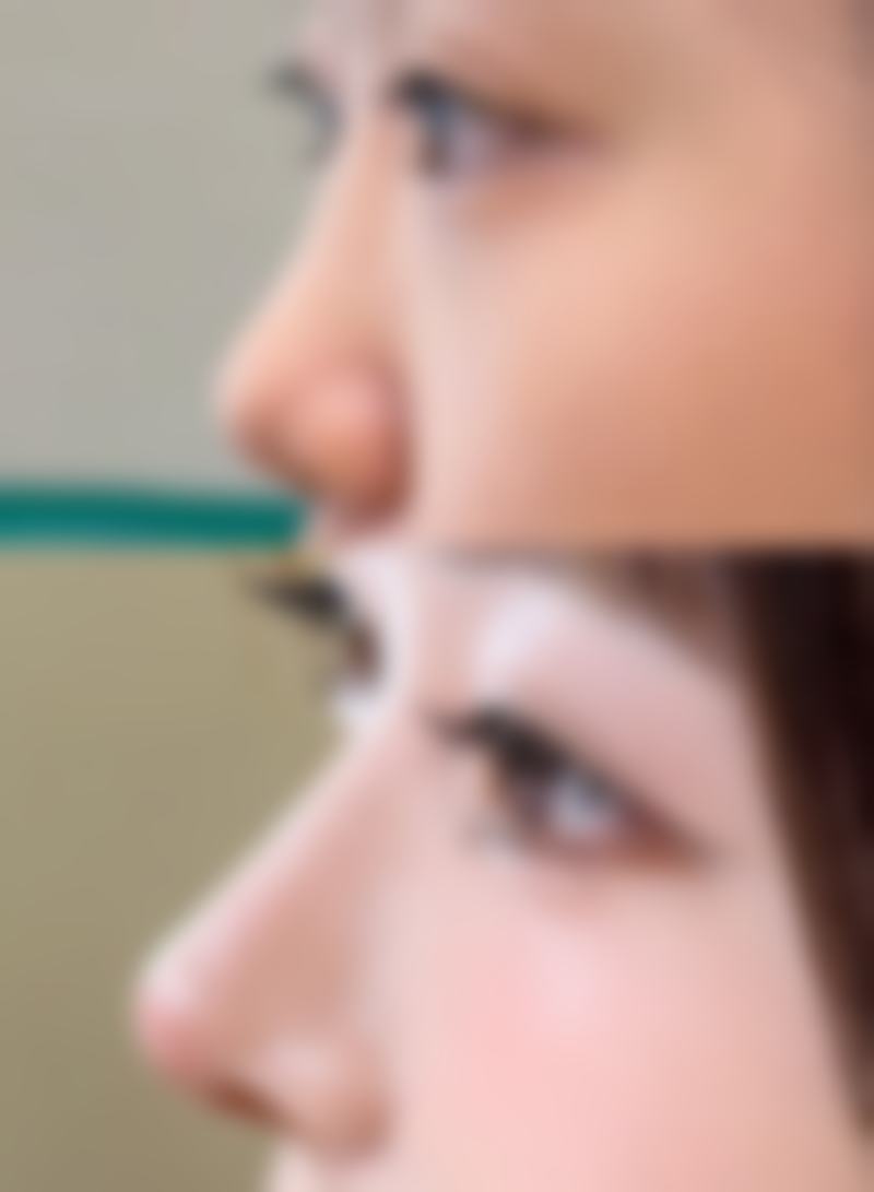 科学看待小孩双眼皮生长有哪些要点