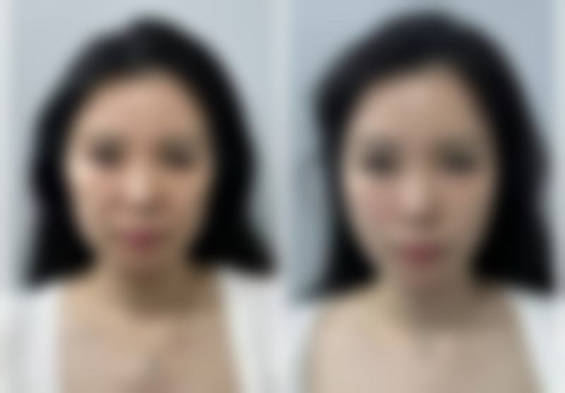 北京圣嘉新医疗美容医院去除脸上疤痕色素沉淀好不好？