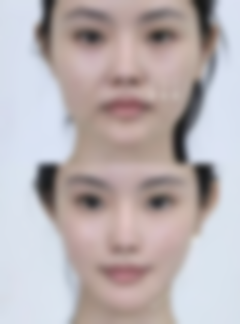 成都新华医院邓娟娟手术价格适合哪些人群？