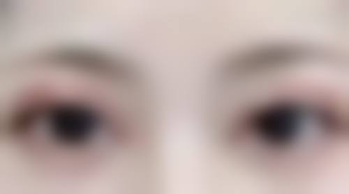 眼部热玛吉适合哪些人群，不适合哪些人群？