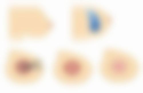 北京加减美医疗美容去除烫伤疤痕增生成效怎么样？