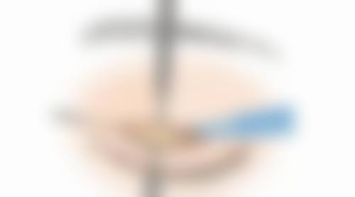 上海王旭东医生处理嗨体打泪沟成眼袋值不值？