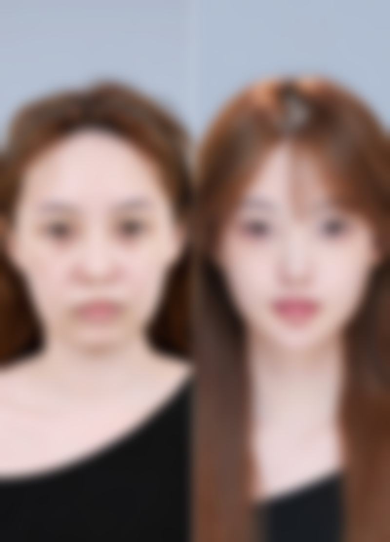 北京画美医疗美容的环吸和大腿抽脂靠谱吗？