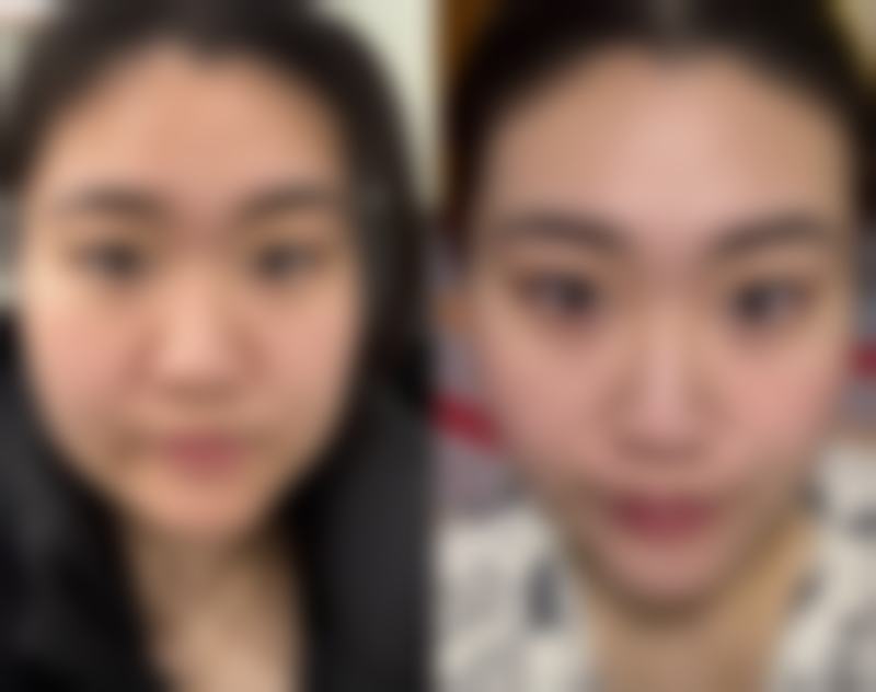 武汉斯启诺医美仪器抗衰实例分享