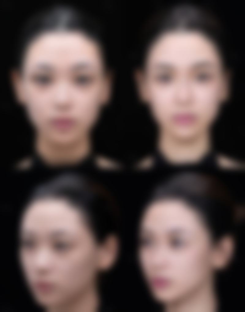 大连爱德丽格医疗美容处理嗨体打泪沟变眼袋成效有保护吗？