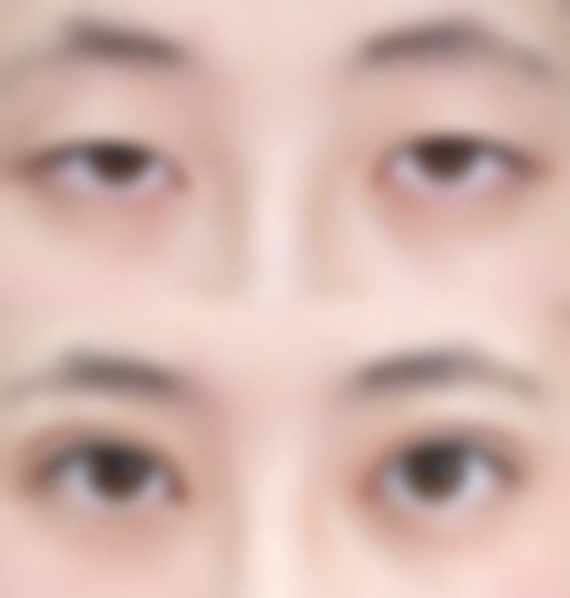 北京嘉禾医疗美容去除凹进去的红色疤痕适合吗？