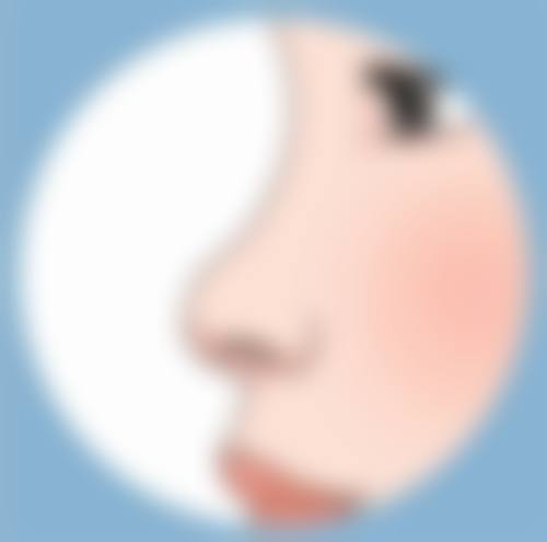 北京圣嘉新医疗美容医院线提升隆鼻变宽的原因靠谱吗