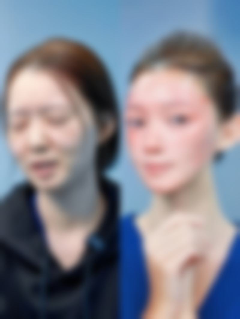 西安莲湖西交疤痕去除脸上痘印疤痕成效怎么样？