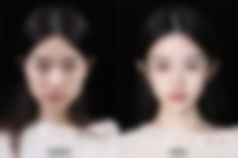 韩国高益秀整形外科线提升隆鼻变宽的概率值不值