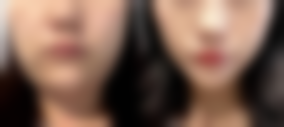 山东济南华颜医疗美容诊所真实实例：美丽蜕变见证