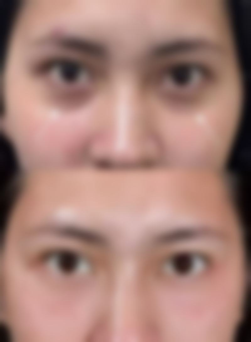 北京丽合医疗美容用冷冻治疗疤痕增生值不值？