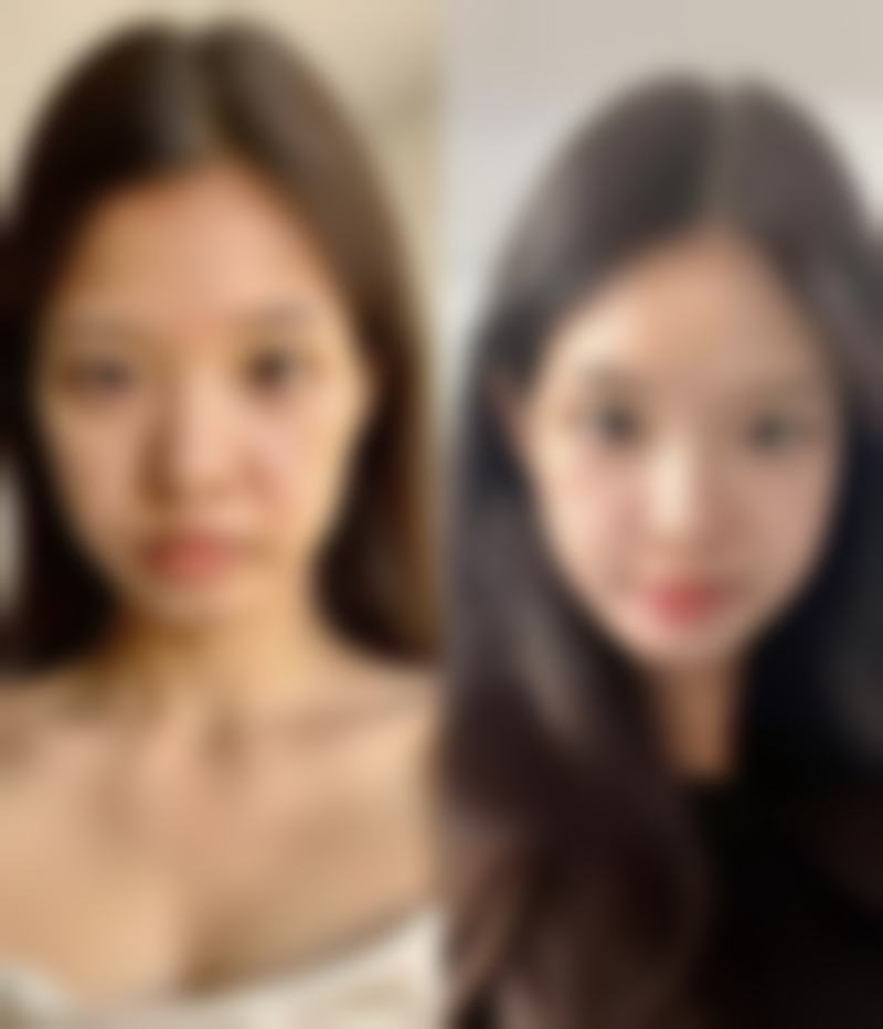 西安莲湖西交疤痕医院去脸上的烧伤疤痕值不值？