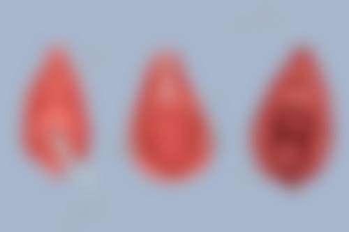 53岁去北京嘉禾医疗美容去眼袋怎么样