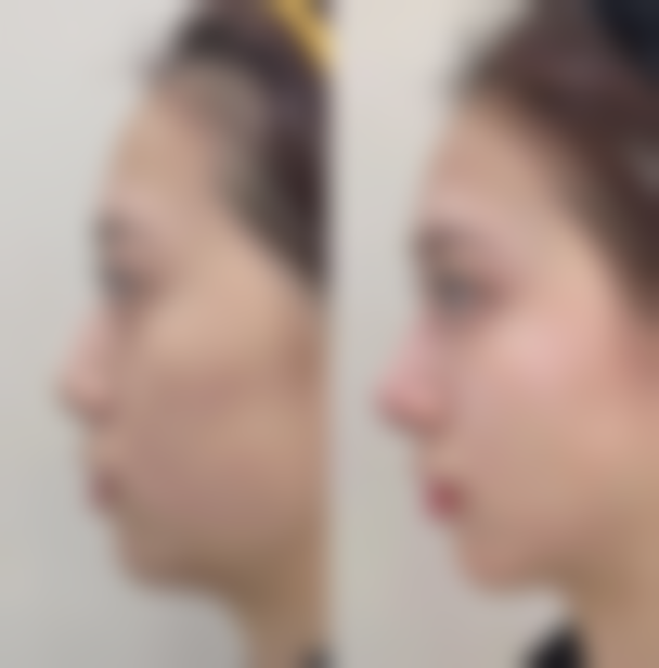 中南大学湘雅医院双眼皮疤痕增生消除期间需要注意什么？