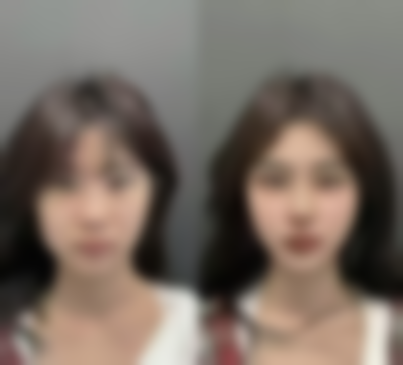 疤痕疙瘩用同位素治疗能治疗好吗？看90%康复案例揭秘同位素治疗优势，让你不再为疤痕疙瘩烦恼！ 