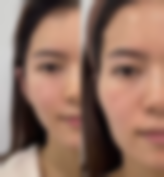 北京画美医疗美容割完双眼皮后喝酒会留疤吗？