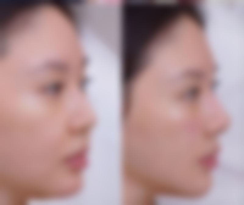 隆胸可以给小孩喂奶吗？权威揭秘隆胸后哺乳真相，3大关键因素决定能否正常喂奶！ 