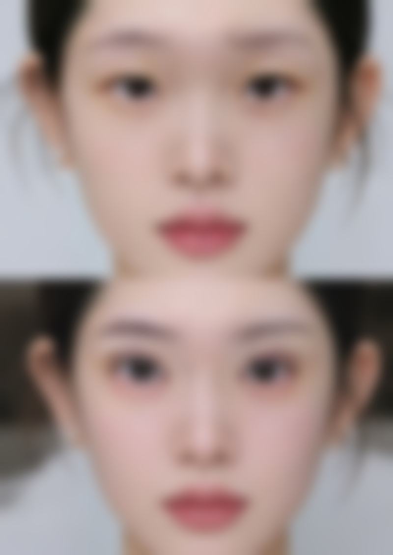 北京圣嘉新医疗美容医院割完双眼皮后30天喝酒合适吗？