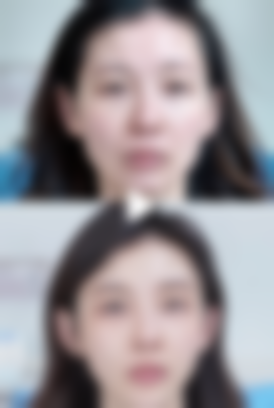 53岁去眼袋选择北京加减美医疗美容适合吗