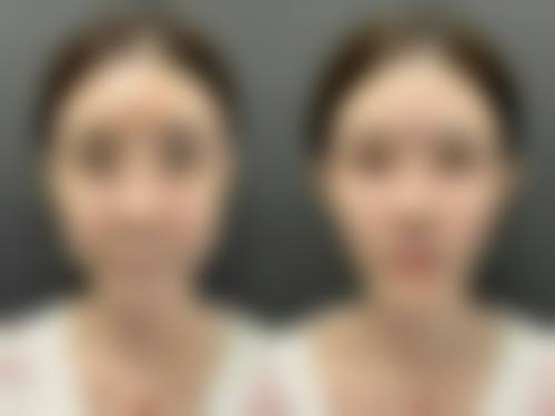 沈阳杏林整形割眼袋后不是疤痕体质擦祛疤药适合吗？