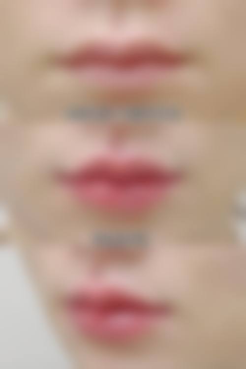 莆田女人花整形医院真实实例:美丽蜕变看得见