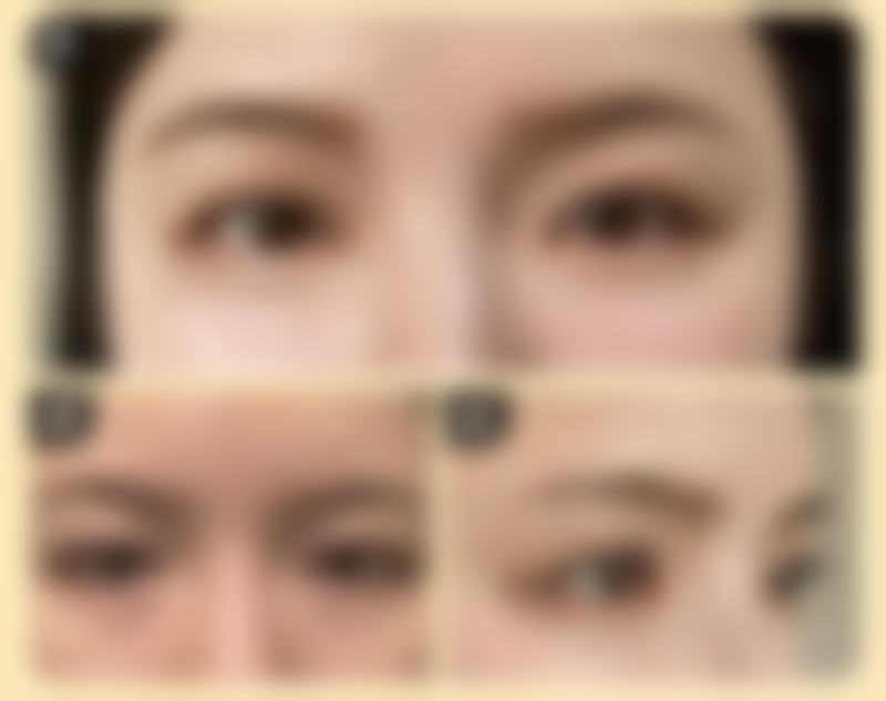 北京画美医疗美容做假体隆胸取出手术细节安排怎么样？