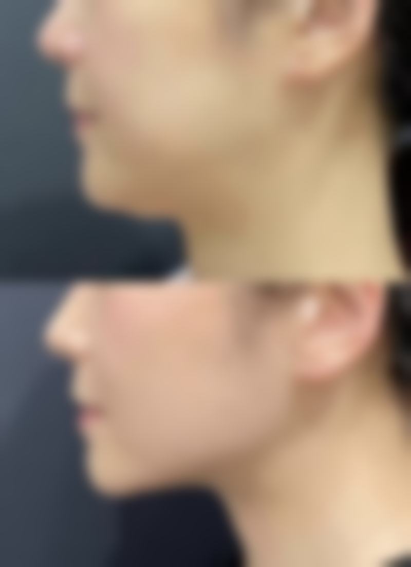 北京禾美嘉医疗美容取出隆胸假体会留疤吗