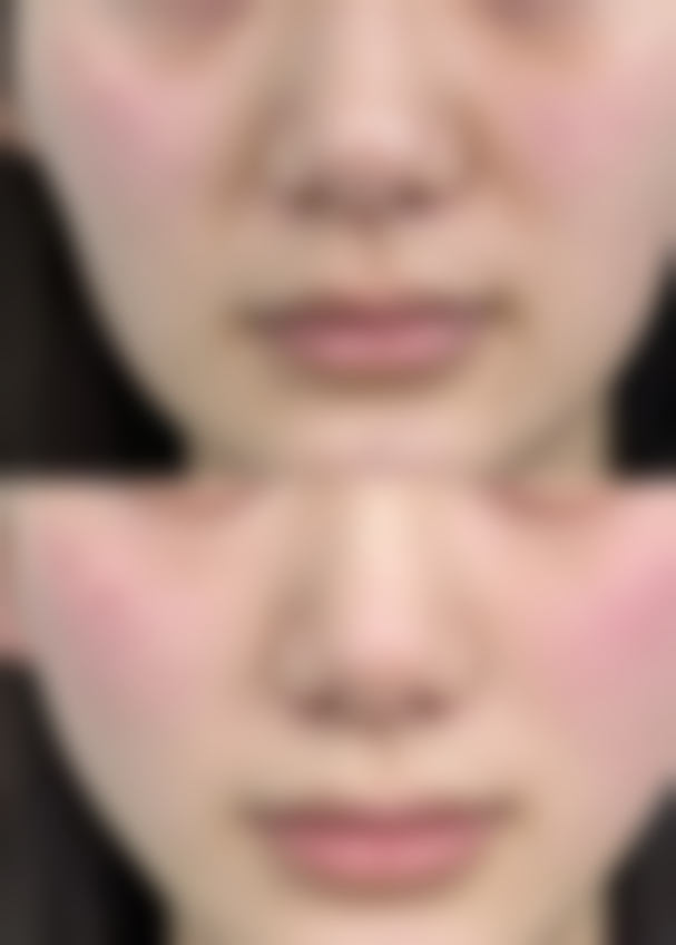 北京嘉禾医疗美容割双眼皮早上肿正常吗？