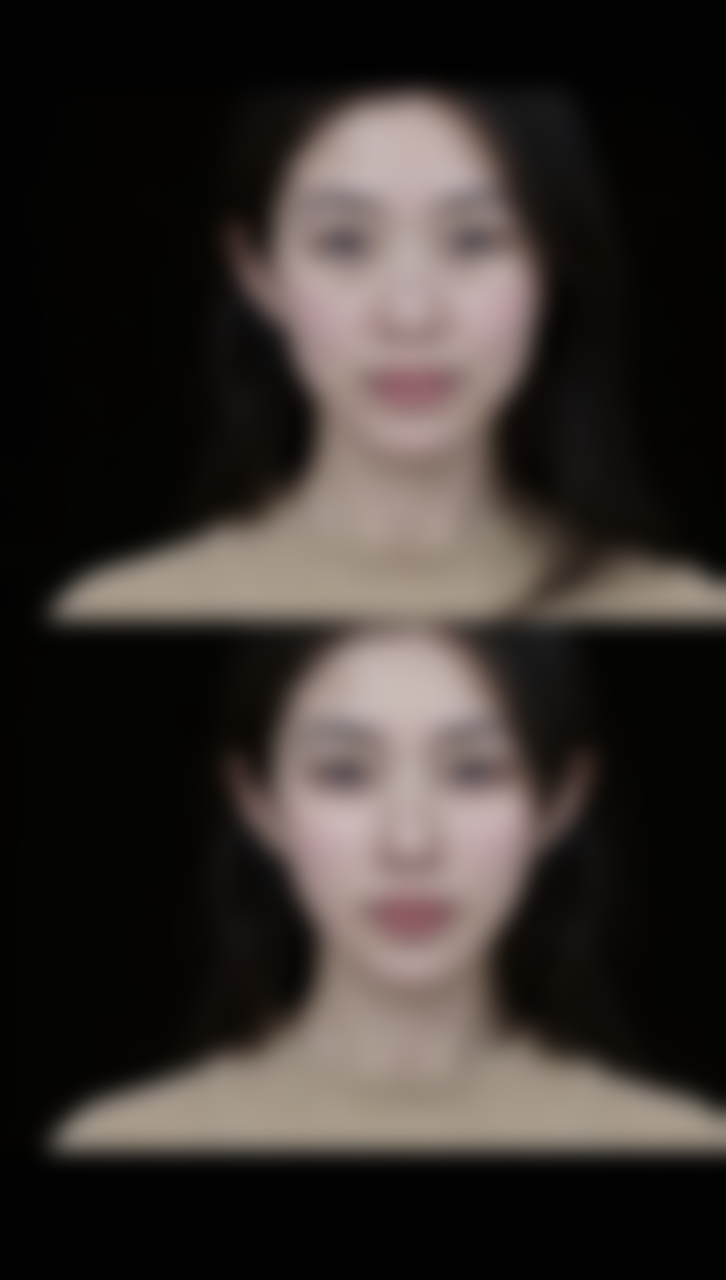 北京画美医疗美容做双眼皮开扇适合吗