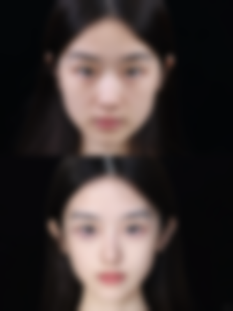 手术增生的疤痕怎么去除？掌握这5种医美方法，轻松告别疤痕烦恼，重获光滑美肌！ 