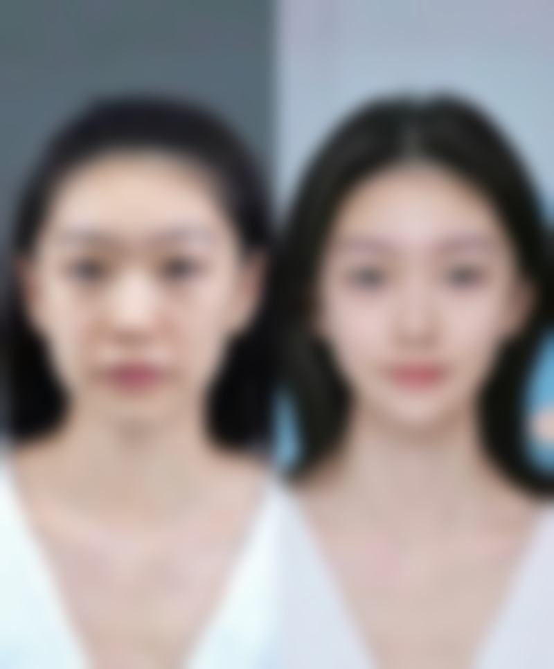 北京嘉禾医疗美容取出隆胸假体后多久能修复正常