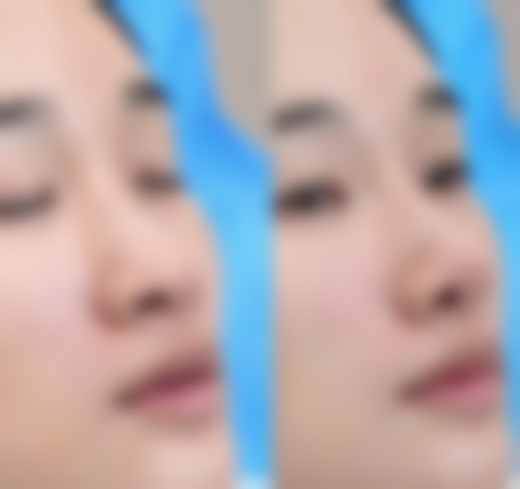 北京嘉禾医疗美容:打完瘦脸针术后护理对修复时间影响大吗?