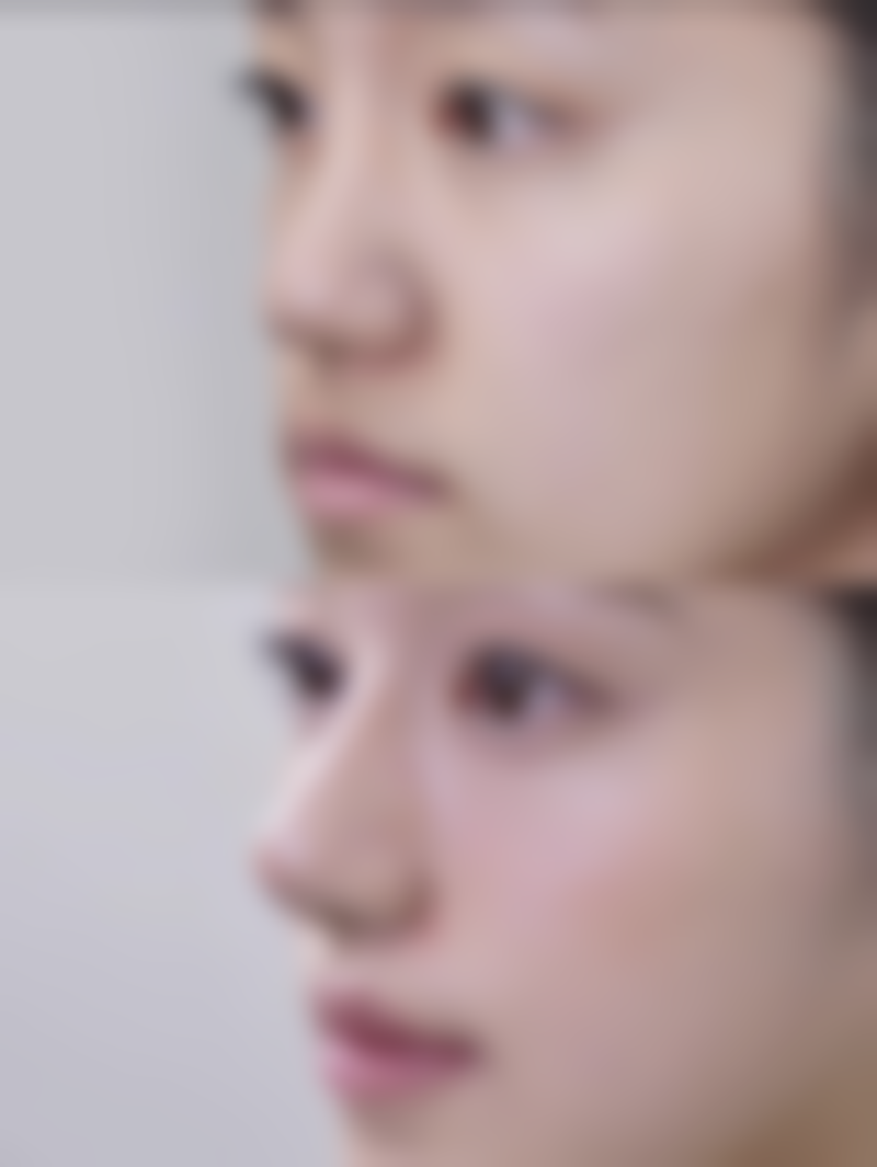 割双眼皮早上肿会影响更终成效吗？