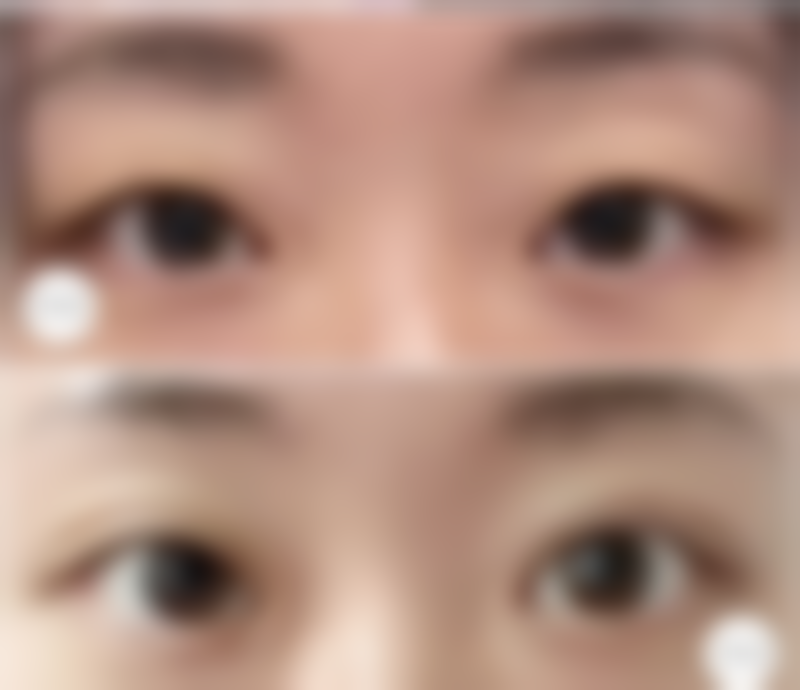 如何让割双眼皮后早上眼皮肿尽快消肿？