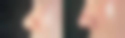 叶锋医生技术特点:精细操作与自然融合